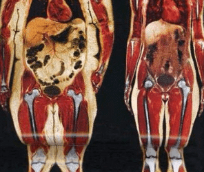 Why Is Weight Gain Hard On Your Joints? by Custom Fitness: Amarillo Personal Trainers